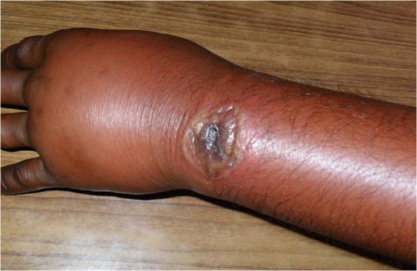 Cutaneous anthrax ulcer on the wrist with marked oedema Blog Template